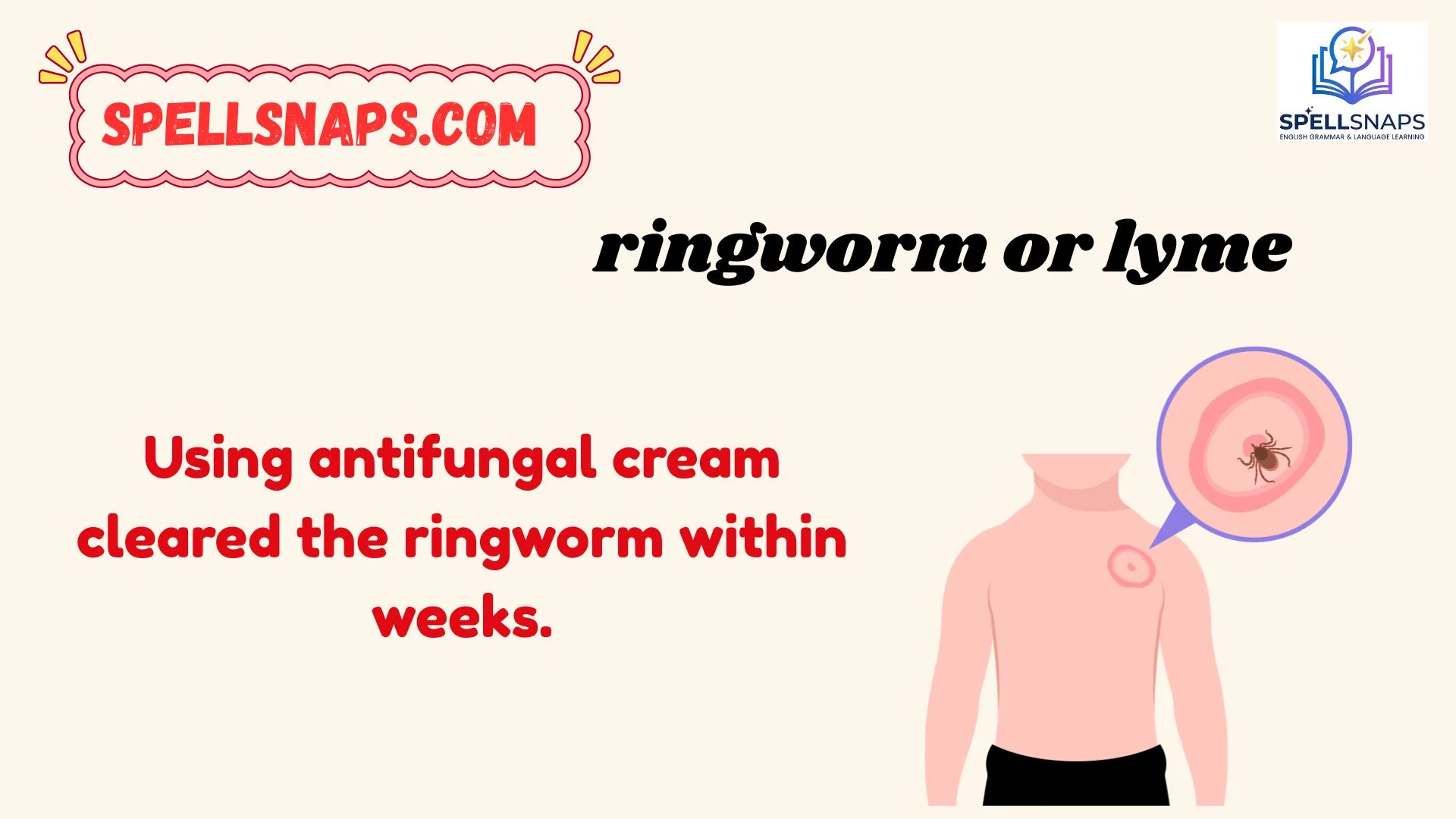 ringworm or lyme